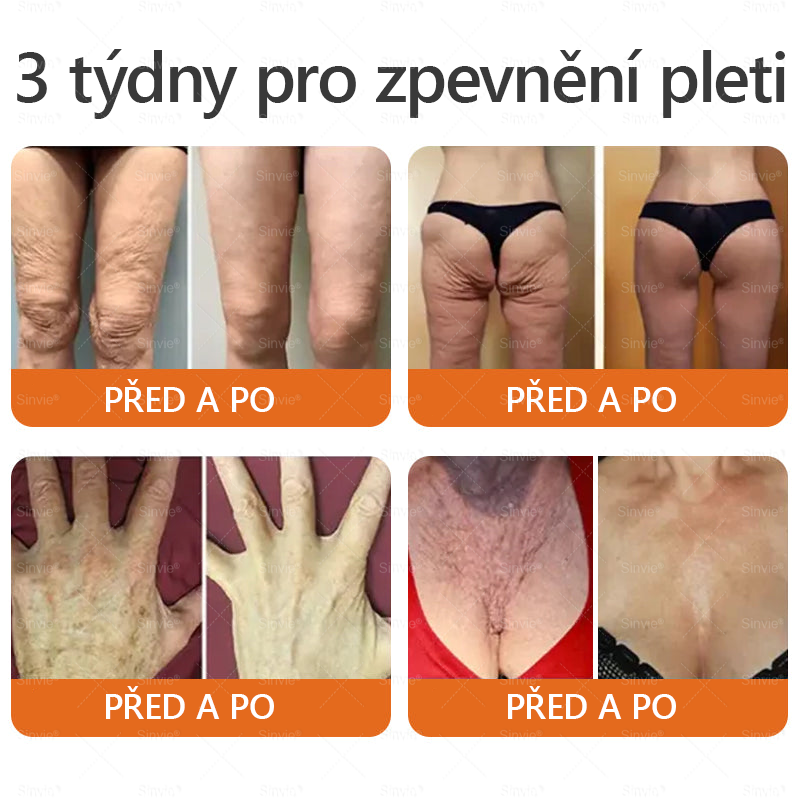 🐝 Sinvie® Krém na obnovu pleti s včelím jedem(👨‍⚕‍CE schváleno)👍✅