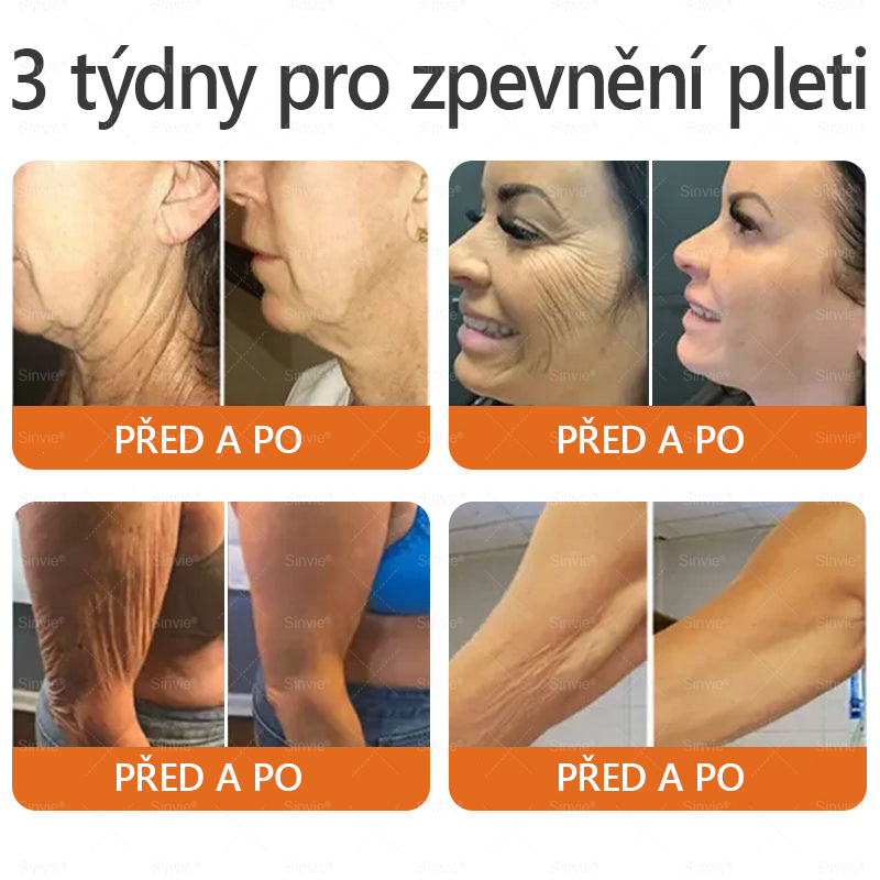 🐝 Sinvie® Krém na obnovu pleti s včelím jedem(👨‍⚕‍CE schváleno)👍✅